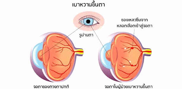ร้านแว่นสายตา Youoptic มีความยินดีที่จะให้ผู้ที่สนใจทางด้านสายตา ได้ศึกษาและอ่านเนื้อหาเกี่ยวกับเรื่องทางด้านสายตา มีความรู้และสามารถนำไปใช้ป้องกันปัญหาทางด้านสายตากันอย่างหลากหลาย เรายินดีจะให้บริการตรวจวัดสายตาฟรี ให้คำปรึกษาปัญหาสายตา ให้คำปรึกษาปัญหาเรื่องแว่นสายตา ปรึกษาปัญหาเรื่องแว่นกันแดด ปรึกษาปัญหาเรื่องกรอบแว่น ปรึกษาปัญหาเรื่องเลนส์ พร้อมมีเลนส์แว่นสายตา เลนส์แว่นกันแดด เลนส์progressive เลนส์กันรังสีสีฟ้า เลนส์กันรังสีUV เลนส์กันรังสีจากแสงอาทิตย์ เลนส์กันรังสีจากคอมพิวเตอร์ ให้ท่านได้ทดสอบ พร้อมจำหน่ายกรอบแว่นสายตา กรอบแว่นกันแดด แว่นสายตา แว่นแบรนด์เนมในราคาถูก ตัดแว่นในราคาถูก เรายินดีให้บริการกับลูกค้าทุกท่าน หมดปัญหาว่าจะตัดแว่นร้านไหนดี ตัดแว่นที่ไหนดี เราแนะนำร้านแว่นสายตา Youoptic