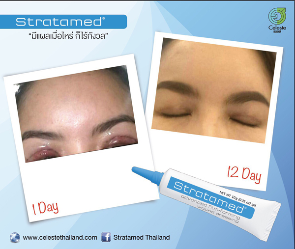 Stratamed ซิลิโคนเจลบริสุทธิ์ 100% หลอดฟ้า 5 g,10 g