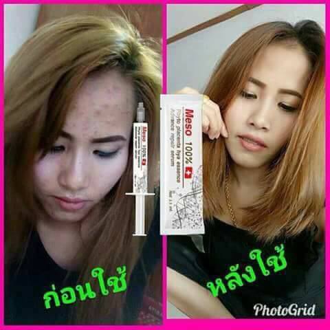 MESO เมโสหน้าใส by เฟิร์น เมโสแบบทา