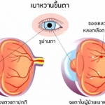 เบาหวานทำให้สายตาสั้นได้ไหม อย่างไร?