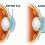 โรคกระจกตาโปน (Keratoconus )